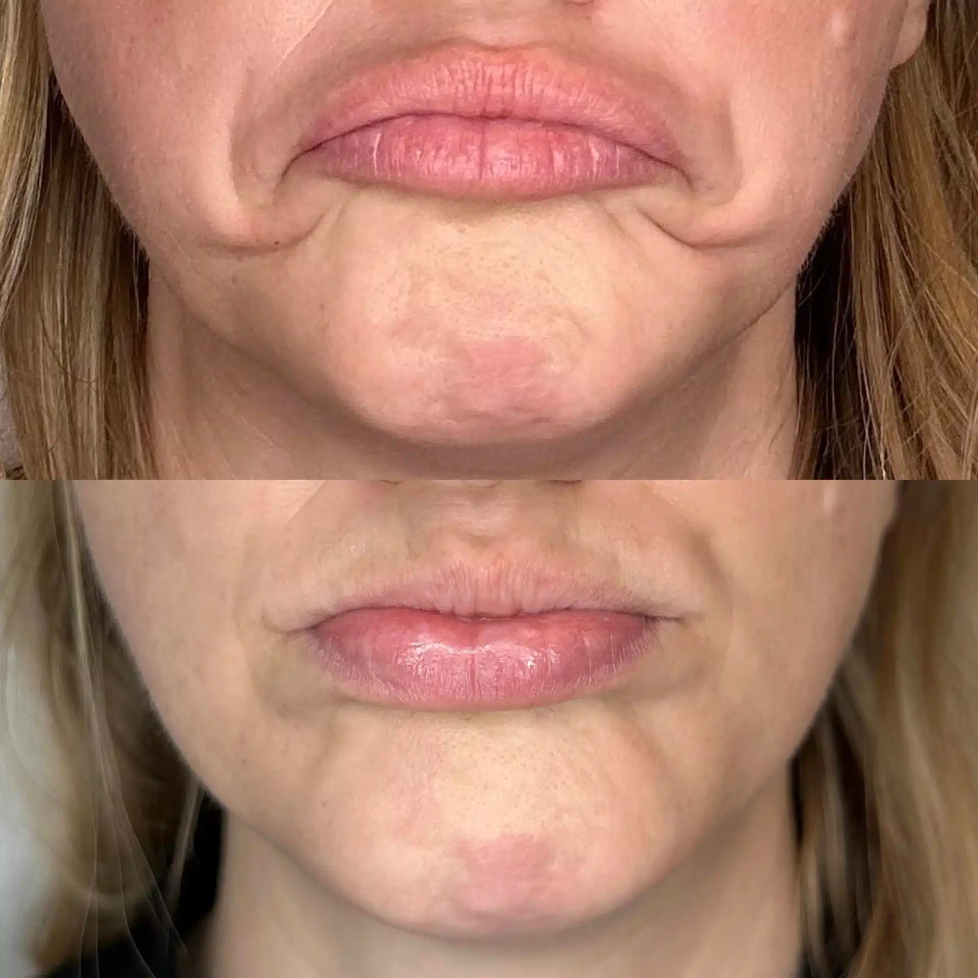 Close-up of a Botox treatment in Fort Collins with visible reduction in lip wrinkles and marionette lines at Facetté Medical Spa.