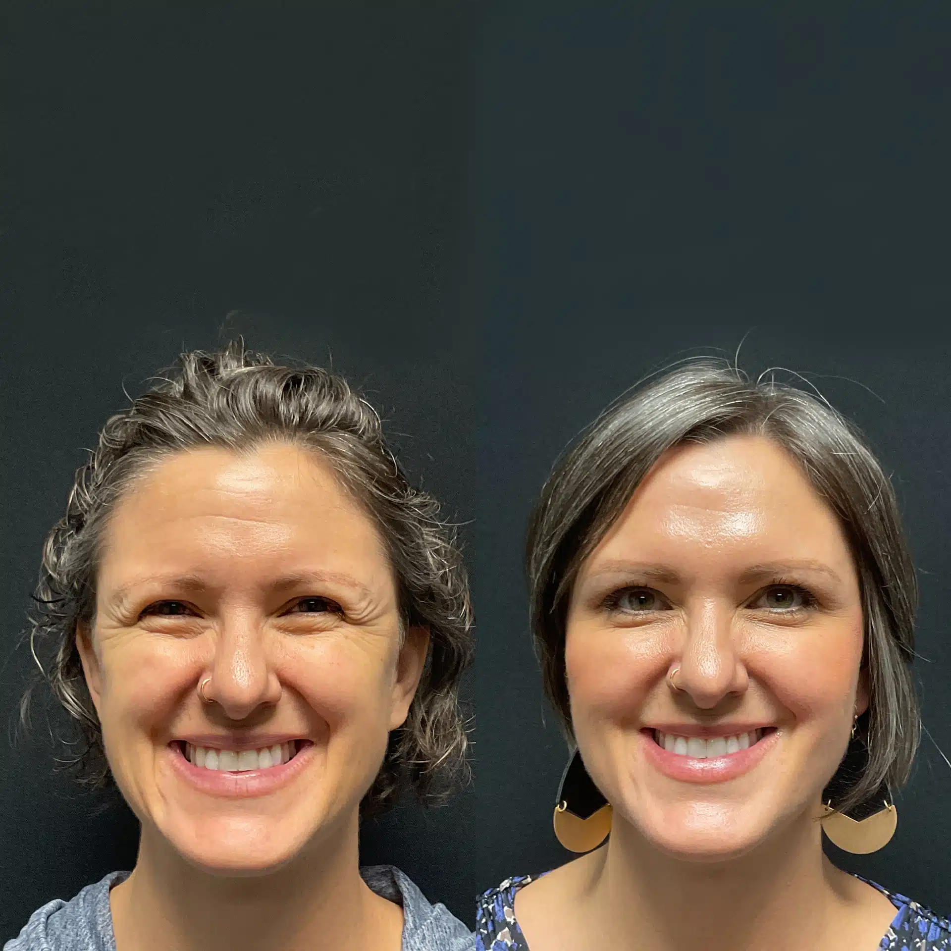 Before and after Botox results in Fort Collins, showing a patient's smoother forehead and reduced wrinkles around the eyes after treatment at Facetté Medical Spa.