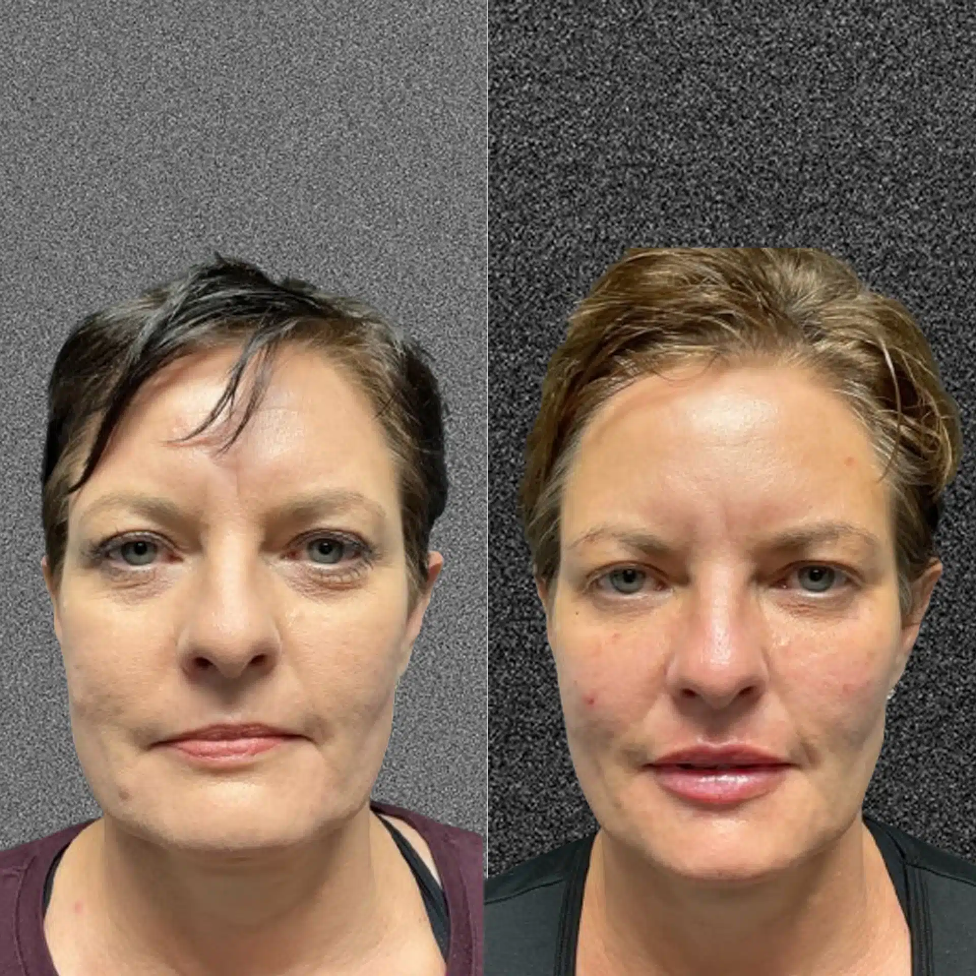 Fort Collins Botox transformation at Facetté Medical Spa, displaying a patient's improved skin texture and reduced frown lines after Botox treatment.