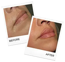 before & after lip filler in fort collins