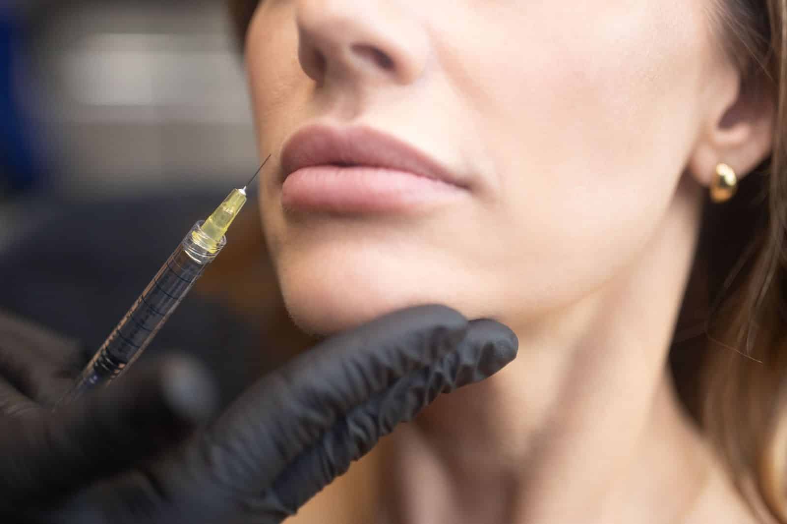 Woman receiving in injection of lip filler in Fort Collins spa