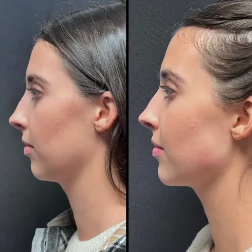 chin and jawline filler