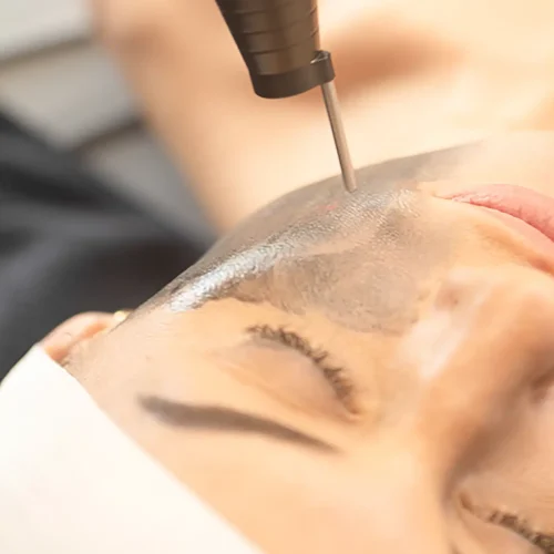 Hollywood Laser Carbon Peel​ Facette